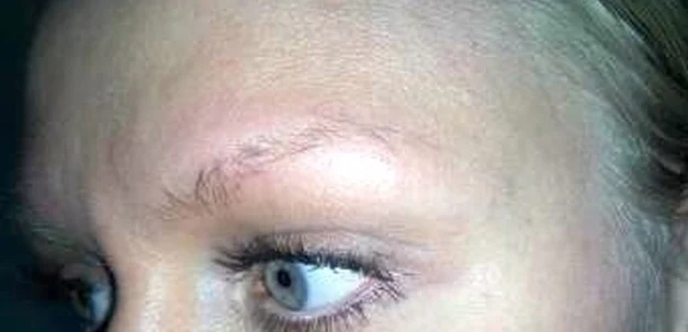 Microblading: before treatment