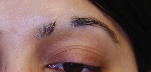 Microblading before treatment