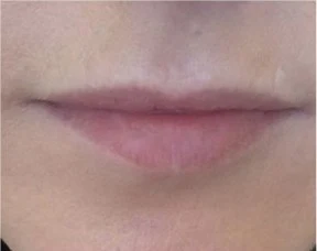 Lip colour before treatment