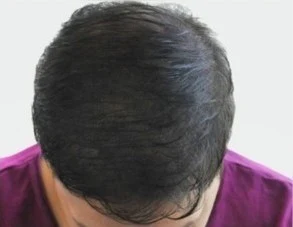 Scalp pigmentation result from Young’s gallery