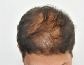 Scalp pigmentation before treatment
