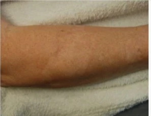 Scar camouflage result from Young’s gallery