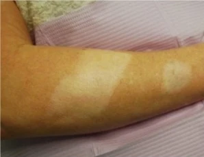 Scar camouflage before treatment